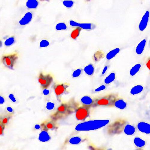 IHC芯片AI分析（個數）